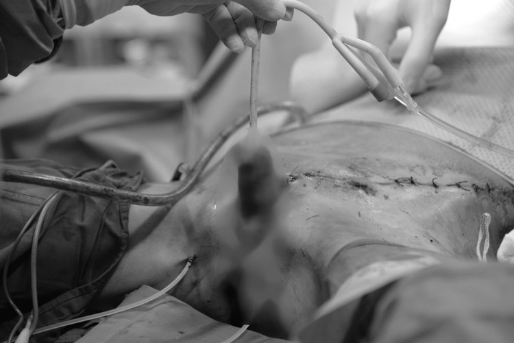 Vùng dương vật sau khi đã được ghép da, tạo hình - Ảnh BVCC