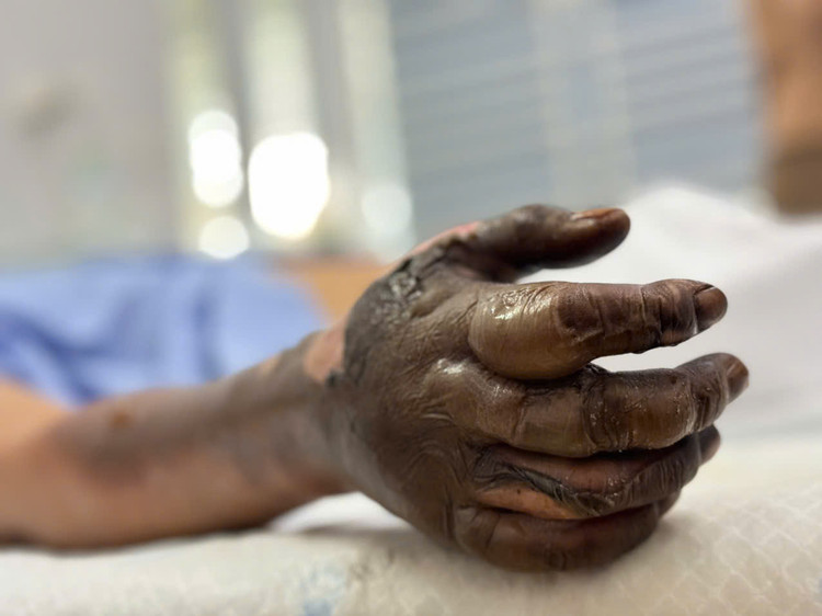 Tay phải của bệnh nhân bị bỏng điện khi vào viện - Ảnh BVCC