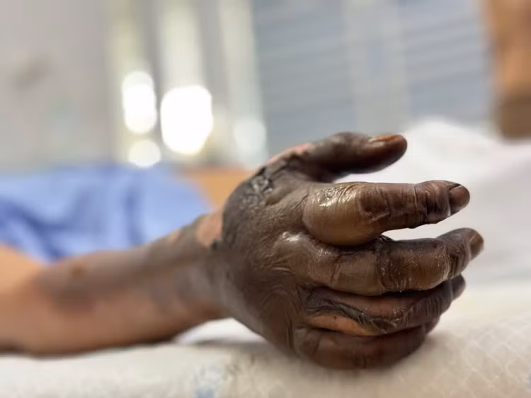 Tay phải của bệnh nhân bị bỏng điện khi vào viện - Ảnh BVCC