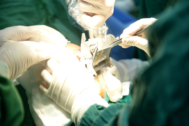 Phần da đầu được lấy bằng máy lấy da chuyên dụng