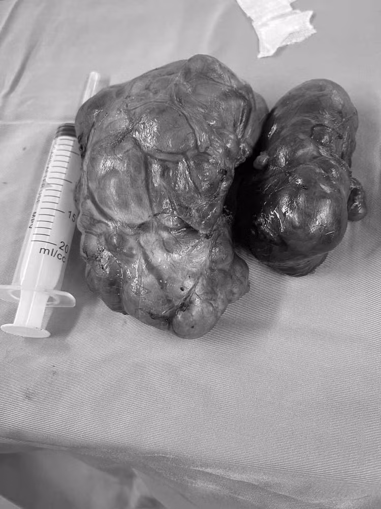 Khối u tuyến giáp khổng lồ được lấy ra