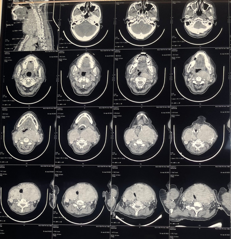Khối u khổng lồ gây chèn ép trên phim chụp