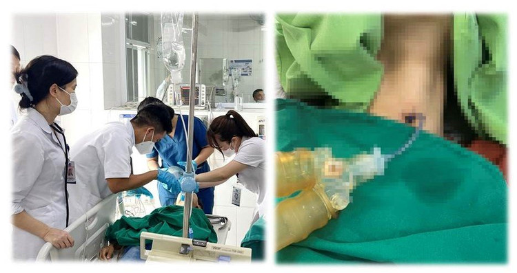 Mở khí quản giúp đưa Canuyn vào khí quản