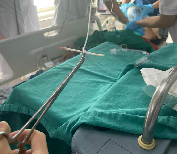 Tăm bông mắc tại khí quản được nội soi lấy ra ngoài