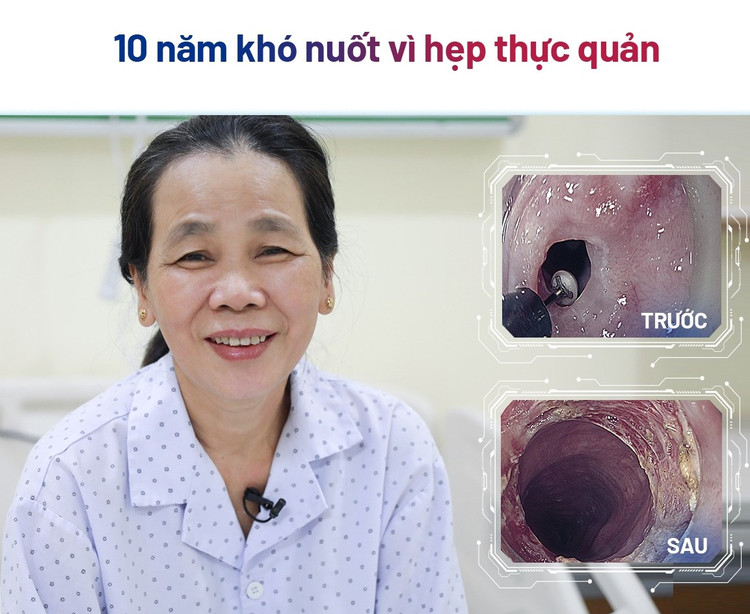 Cắt màng ngăn thực quản giúp người bệnh 56 tuổi thoát khỏi nuốt nghẹn 10 năm ảnh 1