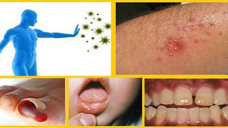 Bệnh nhân đái tháo đường dễ nhiễm trùng và tử vong