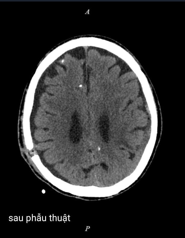 Sau tai nạn giao thông 2 tháng mới phát hiện tụ máu dưới màng cứng ảnh 2