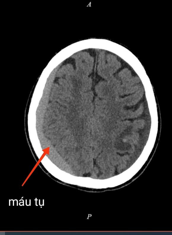 Sau tai nạn giao thông 2 tháng mới phát hiện tụ máu dưới màng cứng ảnh 1