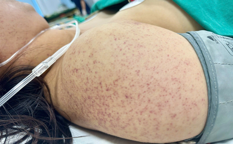 Thai phụ sốt xuất huyết nhập viện trong tình trạng nguy kịch - Ảnh BVCC