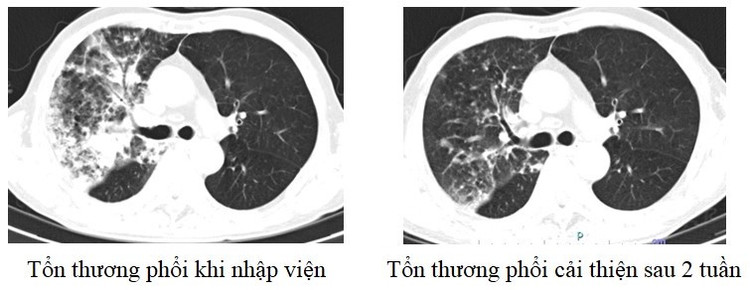 Hình ảnh phổi của người bệnh 75 tuổi trước và sau khi điều trị