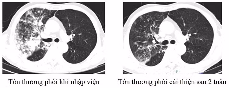 Hình ảnh phổi của người bệnh 75 tuổi trước và sau khi điều trị