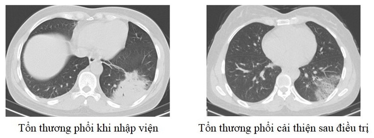 Tổn thương phổi trên phim chụp của bệnh nhân 48 tuổi - Ảnh BVCC