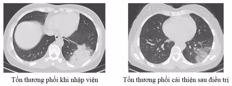 Tổn thương phổi trên phim chụp của bệnh nhân 48 tuổi - Ảnh BVCC