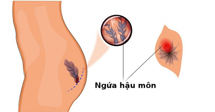 Ngứa hậu môn coi thường cần thận bệnh nguy hiểm