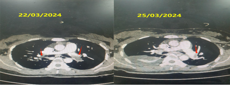 Hình ảnh chụp cắt lớp vi tính động mạch phổi của bệnh nhân trước và 72 giờ sau dùng tiêu sợi huyết. (Mũi tên đỏ chỉ vị trí huyết khối) - Ảnh BVCC