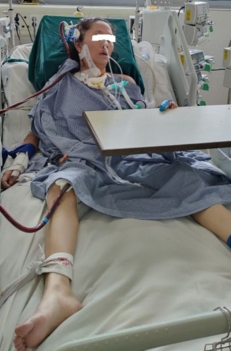 Bệnh nhân can thiệp ECMO 37 ngày, việc chăm sóc và sử dụng kháng sinh rất vất vả do nhiễm vi khuẩn đa kháng