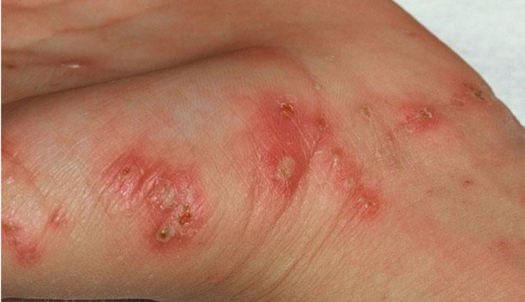 Vết mụn nước đặc trưng của bệnh ghẻ - Ảnh BVCC