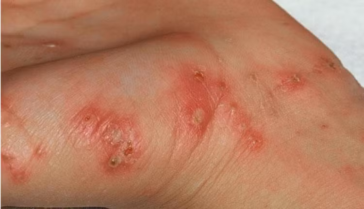Vết mụn nước đặc trưng của bệnh ghẻ - Ảnh BVCC