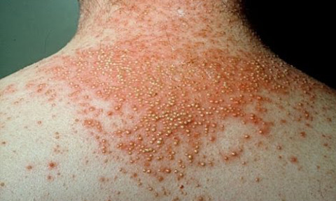 Ghẻ trên da vai, gáy bệnh nhân - Ảnh BVCC