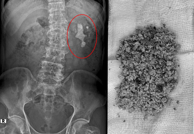 Sỏi thận trên phim chụp và được lấy ra - Ảnh BVCC