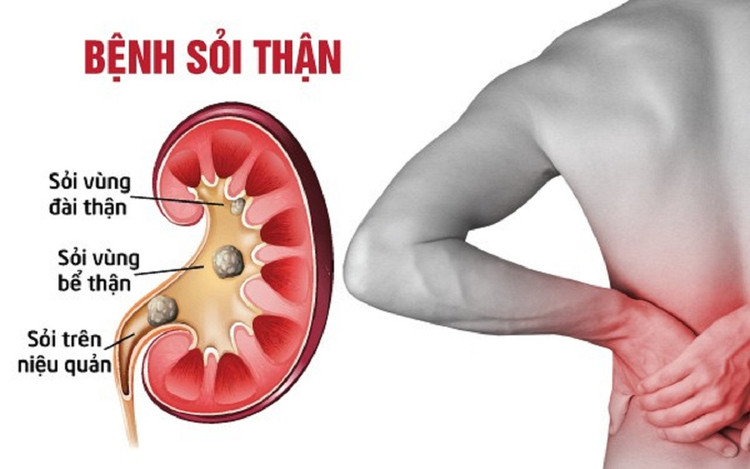 Sỏi thận - Ảnh minh họa