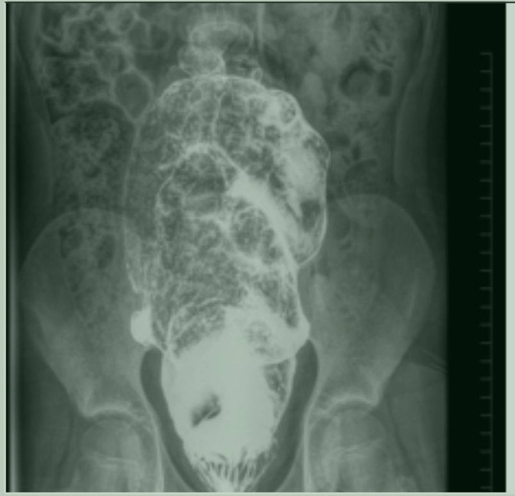 Phần ruột bệnh nhi lúc nào cũng ứ đọng phân trong khung đại tràng - Ảnh BVCC