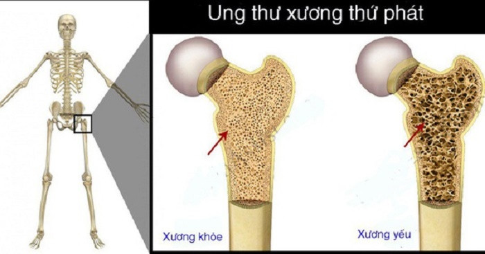 Dấu hiệu cảnh báo ung thư xương - Ảnh minh họa