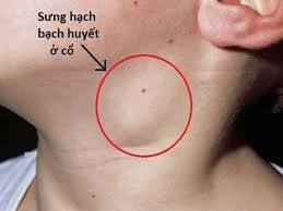 Sưng hạch bạch huyết ở cổ - Ảnh: BSCC