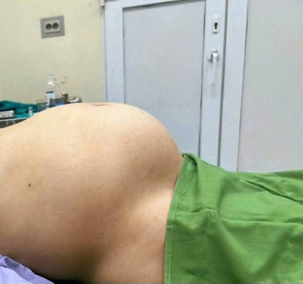 Bụng của người bệnh to như mang thai 8 tháng - Ảnh BVCC