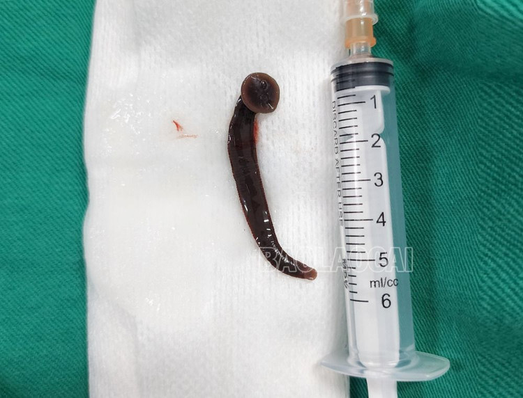 Dị vật là con đỉa dài hơn 5 cm - Ảnh: BVCC
