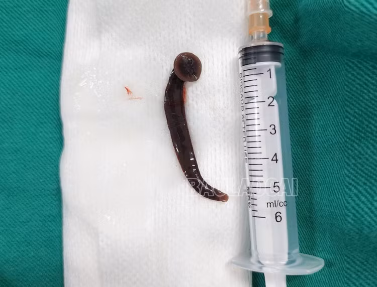 Dị vật là con đỉa dài hơn 5 cm - Ảnh: BVCC