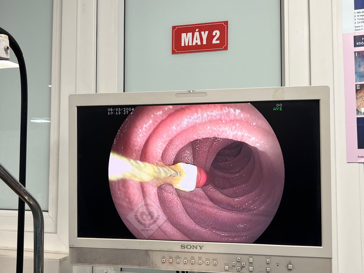 Nội soi phát hiện thấy kim diệt tuỷ răng nằm dưới khúc III tá tràng