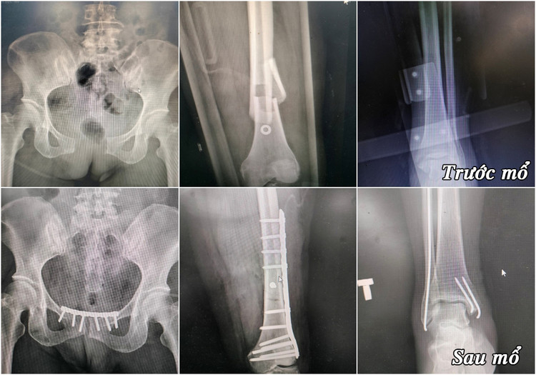 Hình ảnh xương gãy của bệnh nhân trước và sau mổ