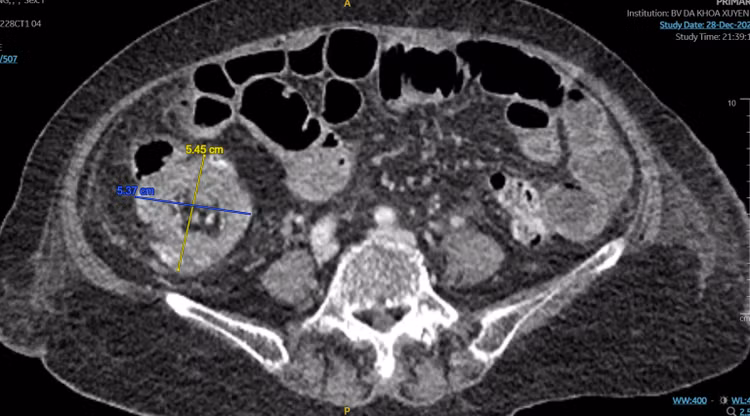 Hình ảnh khối u trên CT - Ảnh BVCC