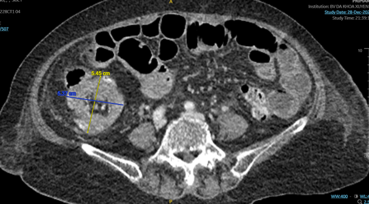 Hình ảnh khối u trên CT - Ảnh BVCC