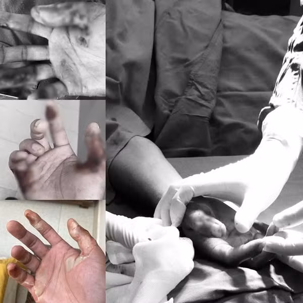 Tay hoại tử, co rút vì bôi cao sim vào vết bỏng - Ảnh BVCC