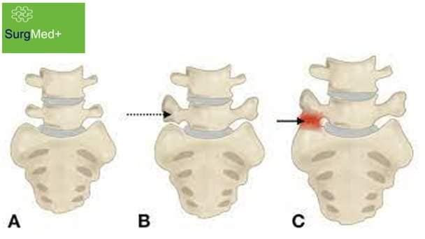 Đau lưng mạn tính, dai dẳng do hội chứng Bertolotti ảnh 1 Đau lưng mạn tính, dai dẳng do hội chứng Bertolotti ảnh 1
