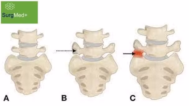 Đau lưng mạn tính, dai dẳng do hội chứng Bertolotti ảnh 1