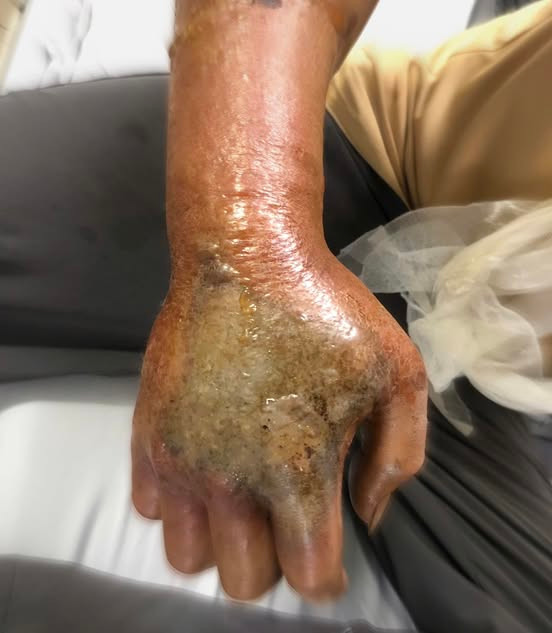 Hoại tử nghiêm trọng bàn tay vì đắp thuốc Nam khi bị rắn hổ mang cắn - Ảnh BVCC