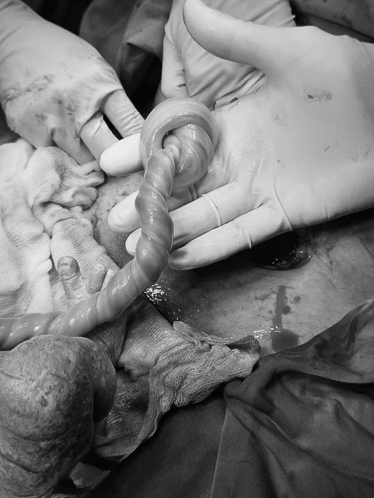 Dây rốn thắt nút - Ảnh BVCC