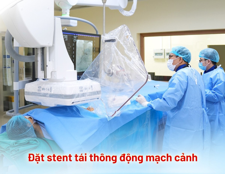 Can thiệp tái thông động mạch cảnh - Ảnh BVCC
