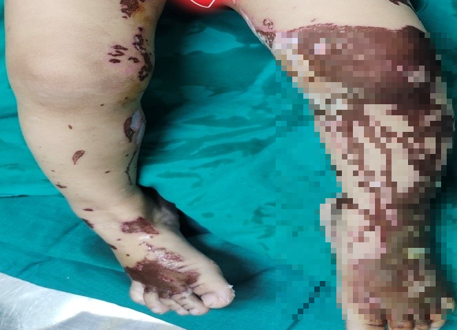 Tổn thương bỏng acid của cháu bé khi mới nhập viện - Ảnh BVCC