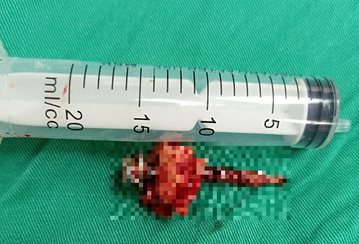 Hình ảnh chiếc đinh được rút ra khỏi đầu bệnh nhân - Ảnh BVCC