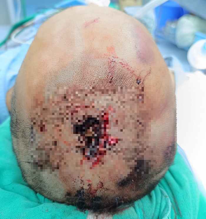 Hình ảnh chiếc đinh được cắm sâu vào đầu bệnh nhân - Ảnh BVCC
