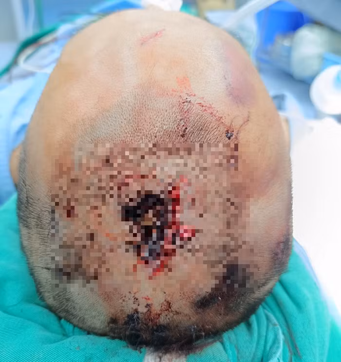 Hình ảnh chiếc đinh được cắm sâu vào đầu bệnh nhân - Ảnh BVCC