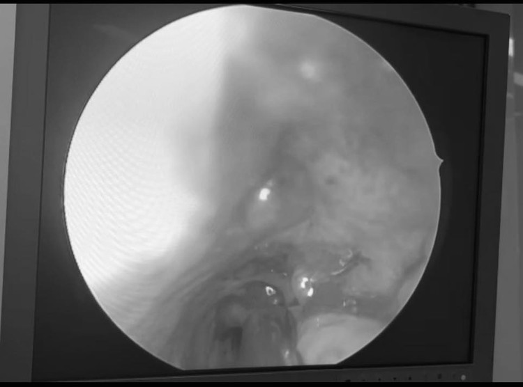 Phải mổ cấp cứu và truyền máu khẩn cấp vì chảy máu mũi ảnh 1