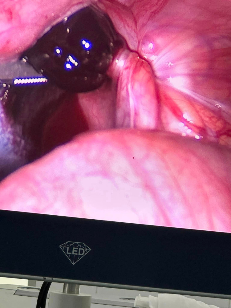 Buống trứng và vòi tử cung bị xoắn vặn trên nội soi