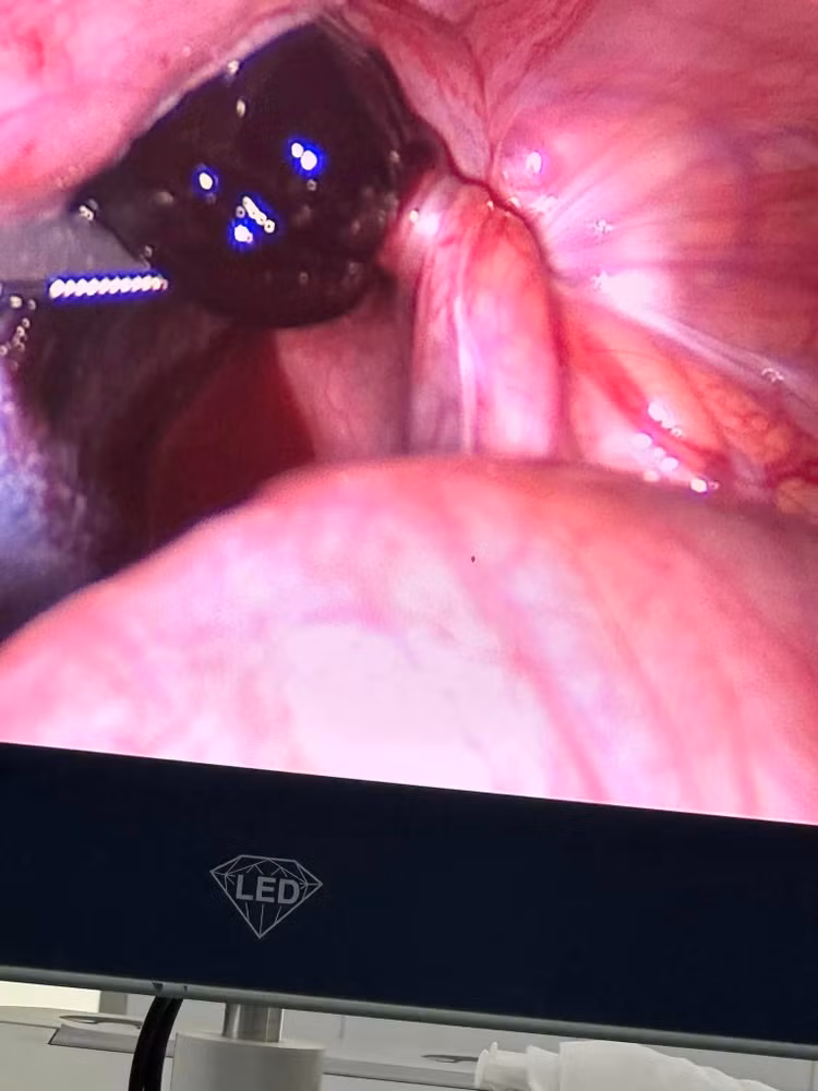 Buống trứng và vòi tử cung bị xoắn vặn trên nội soi