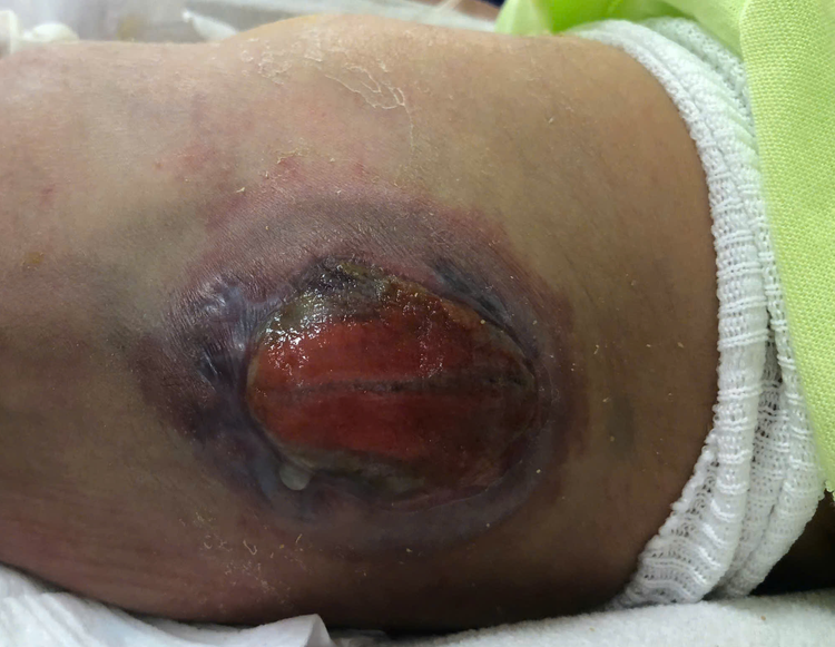 Khối thoát vị tủy ra bên ngoài ống sống - Ảnh BVCC