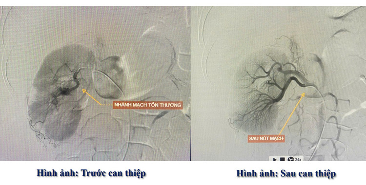 Dị dạng động tĩnh mạch thận hiếm gặp trước và sau can thiệp - Ảnh BVCC